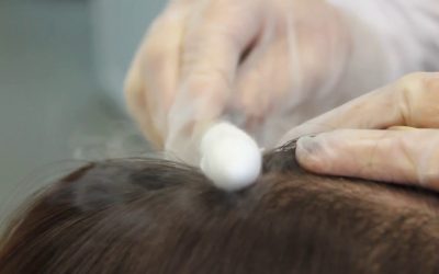 Криотерапия волос